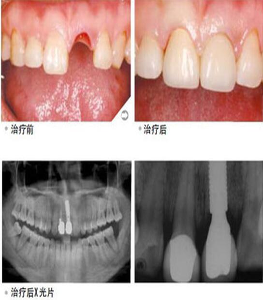 西寧牙齒種植